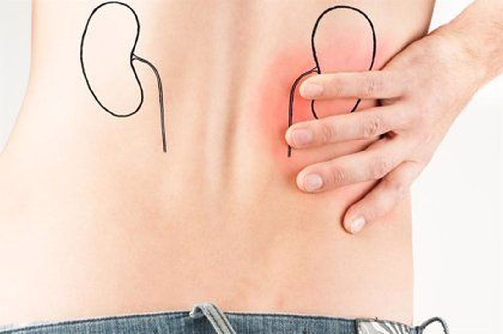 Enfermedad renal. Foto Infosalus