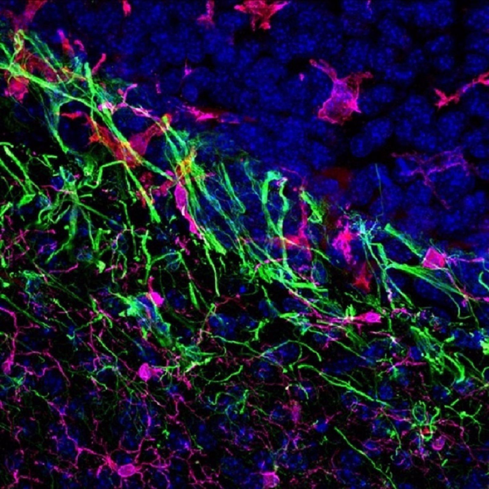 Metástasis cerebral de melanoma en ratón. Europa Press