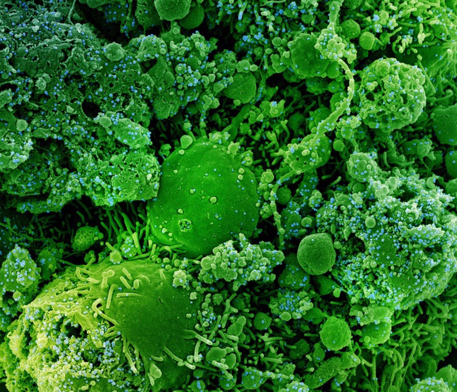 Micrografía electrónica de barrido coloreada de células infectadas crónicamente y parcialmente lisadas (verde) infectadas con una cepa variante de partículas del virus SARS-CoV-2 (azul), aisladas de una muestra de un paciente.