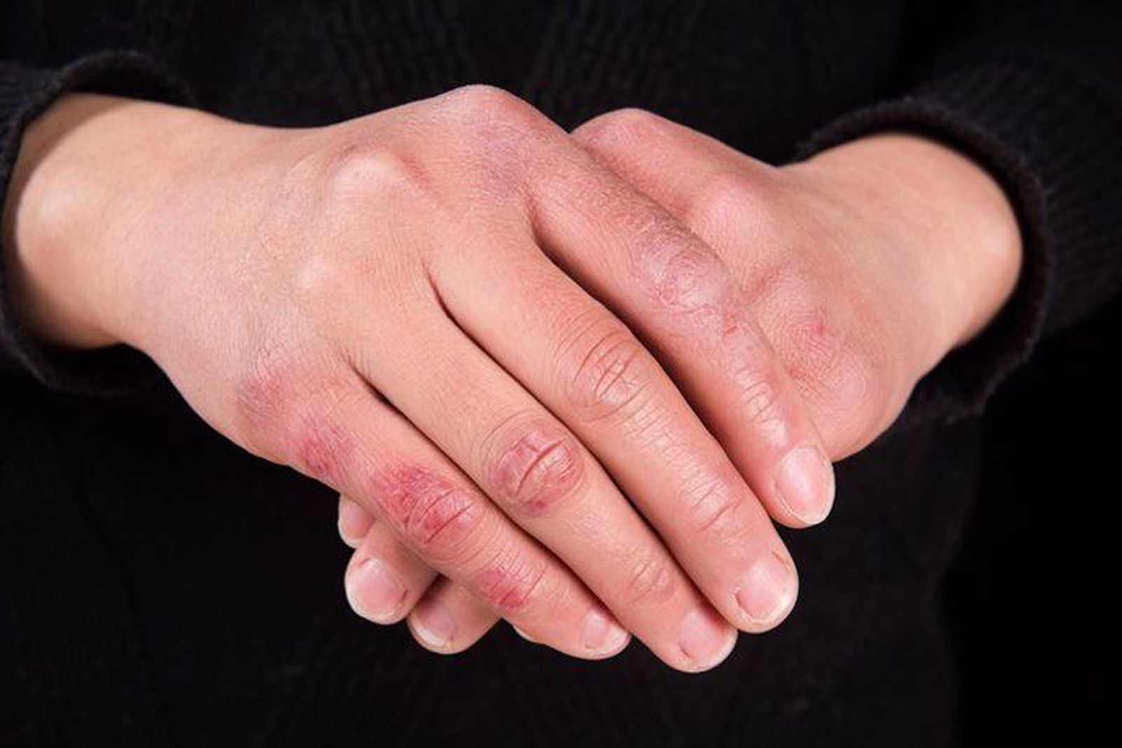 Sabañones en la piel. Foto Infosalus