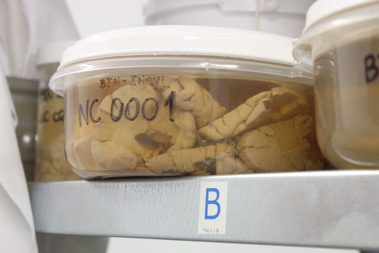 Donación del cerebro para la investigación.