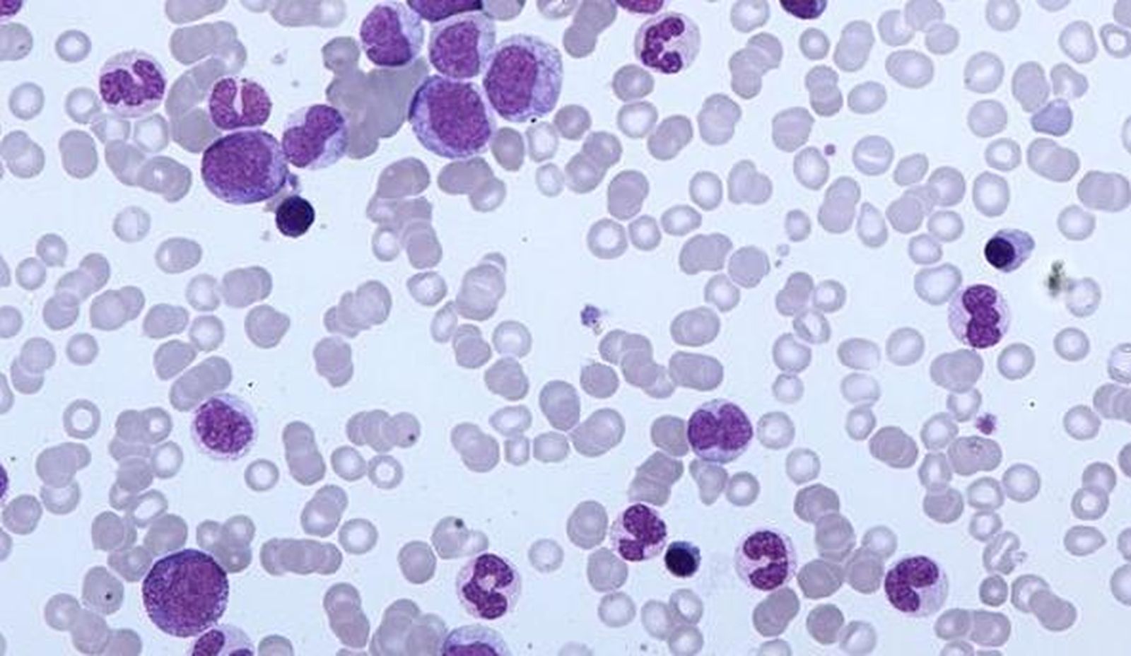 Investigadores hallan una estrategia no tóxica para tratar la leucemia