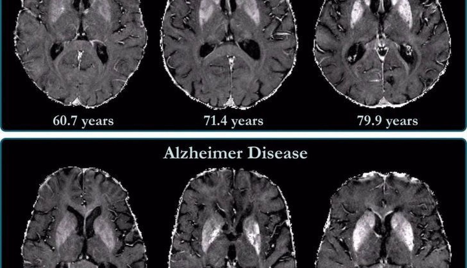 La acumulacion de hierro en el cerebro esta relacionada con el deterioro cognitivo en pacientes con alzheimer 1 728x418