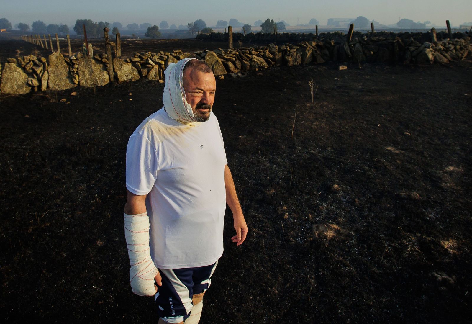 José Manuel Blanco, con quemaduras en varias partes del cuerpo, observa la zona arrasada el incendio forestal de Cipérez