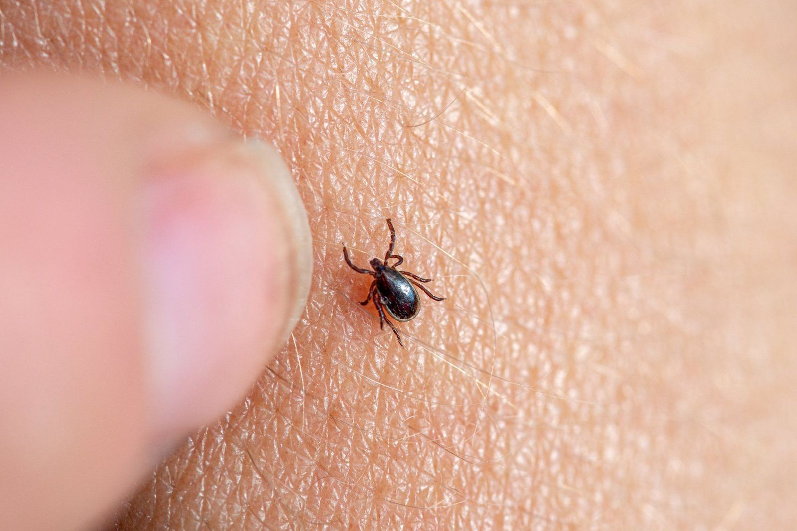 Imagen de una garrapata marrón en la piel humana con un dedo femenino a punto de retirarla. - FUNDACIÓN SOS LYME - Archivo Imagen de una garrapata marrón en la piel humana con un dedo femenino a punto de retirarla. - FUNDACIÓN SOS LYME - Archivo