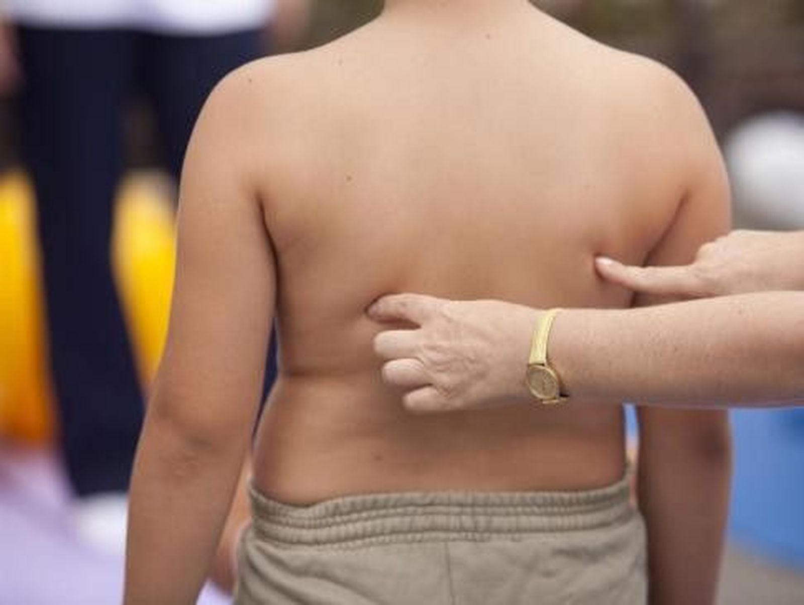 Preocupa la obesidad y el sobrepeso entre los jóvenes españoles