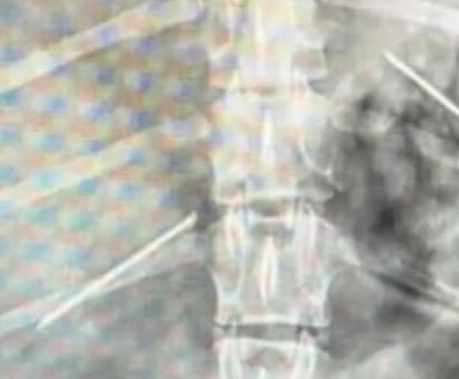 Alfileres en el interior de un perro afectado por las salchicas en Garrido