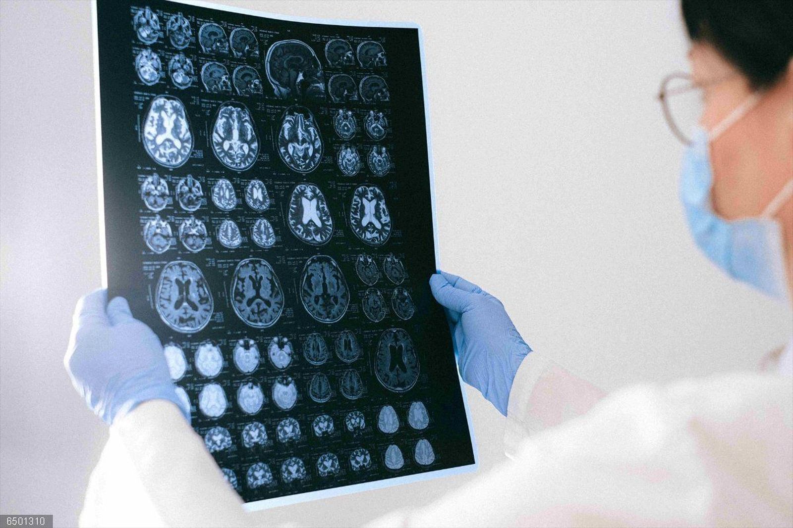 Epilepsia. Foto EP