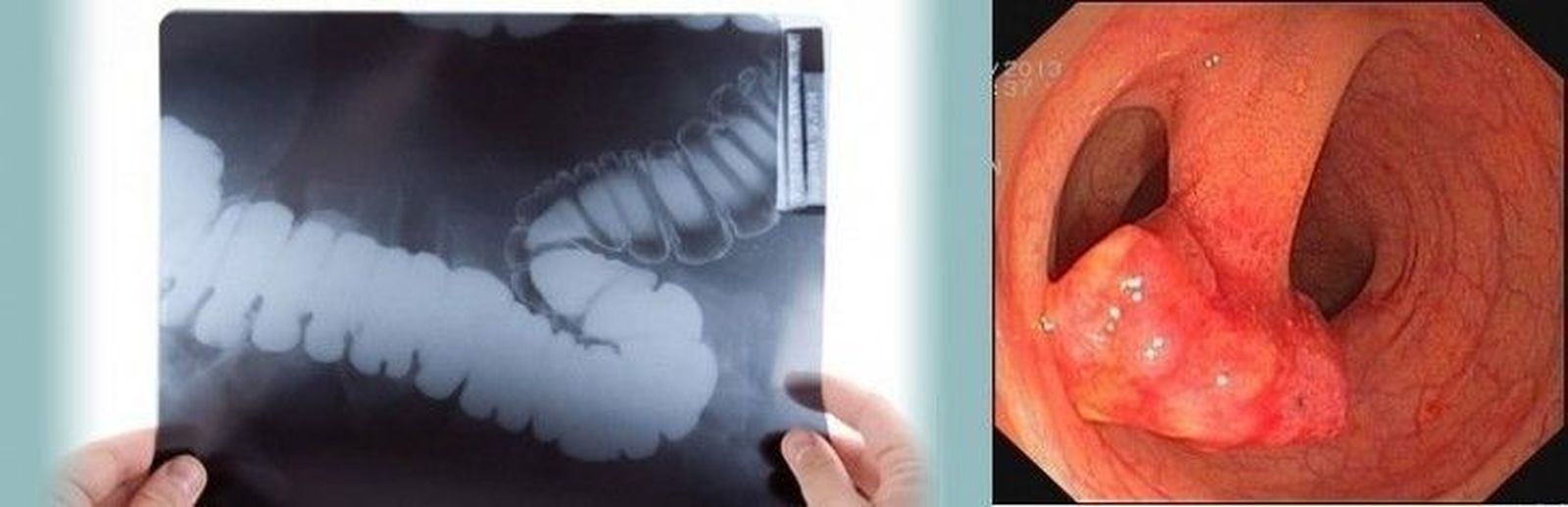 El Sistema Nacional de Salud incorpora el cribado de cáncer de colon