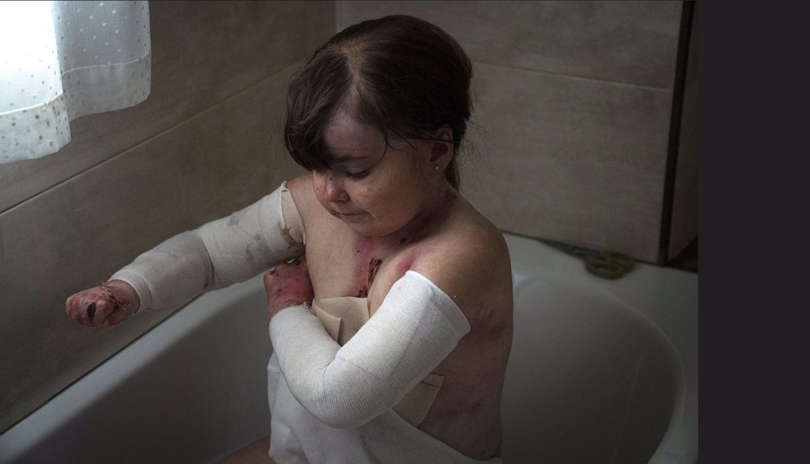 Archivo - La burocracia sanitaria “está abriendo heridas” de pacientes con Piel de Mariposa - MARTÍN CORRADINI/ ONG DEBRA PIEL DE MARIPOSA