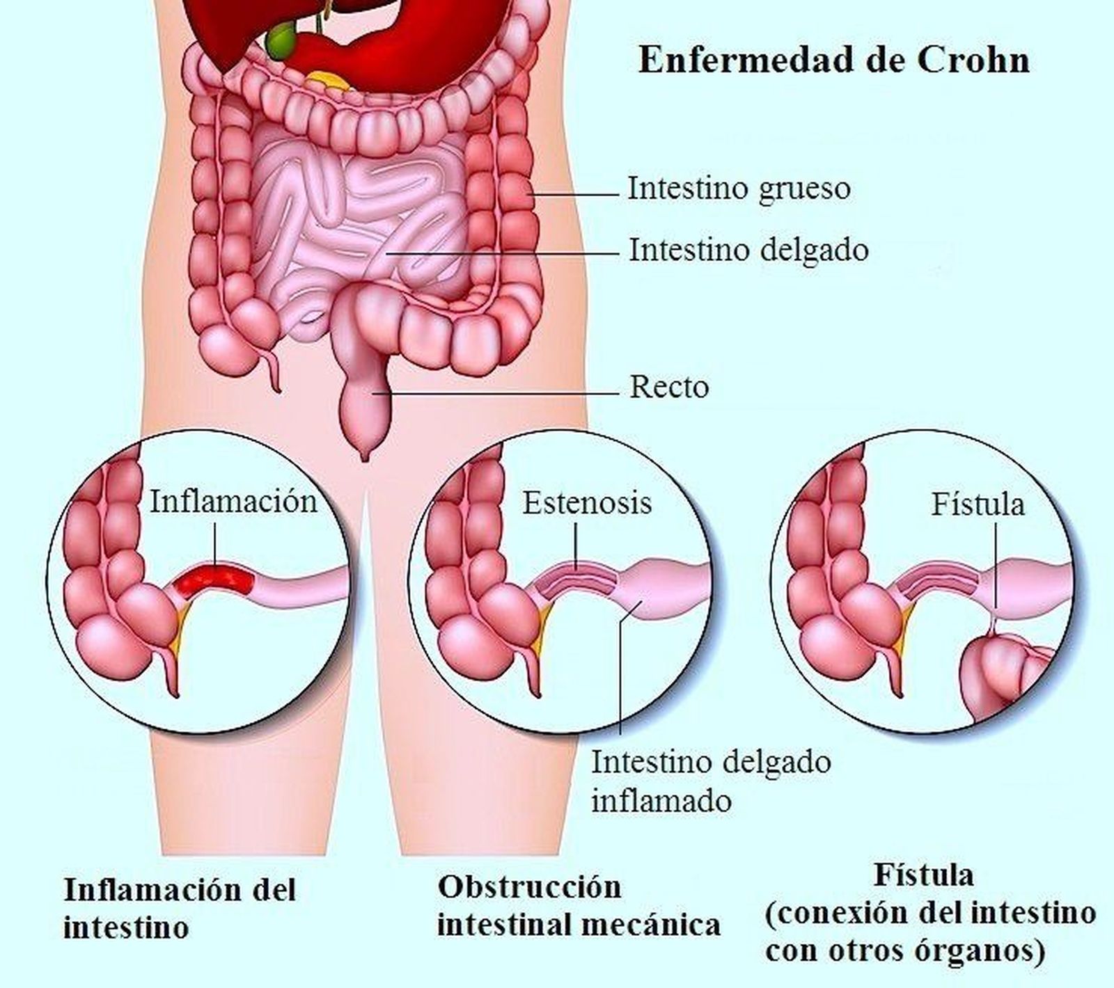 Diez consejos para controlar la Enfermedad de Crohn 