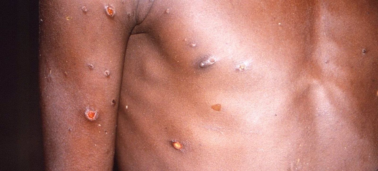 La viruela del mono produce lesiones cutáneas, fiebre y dolor corporal en las personas afectadas por el virus.   CDC   Archivo