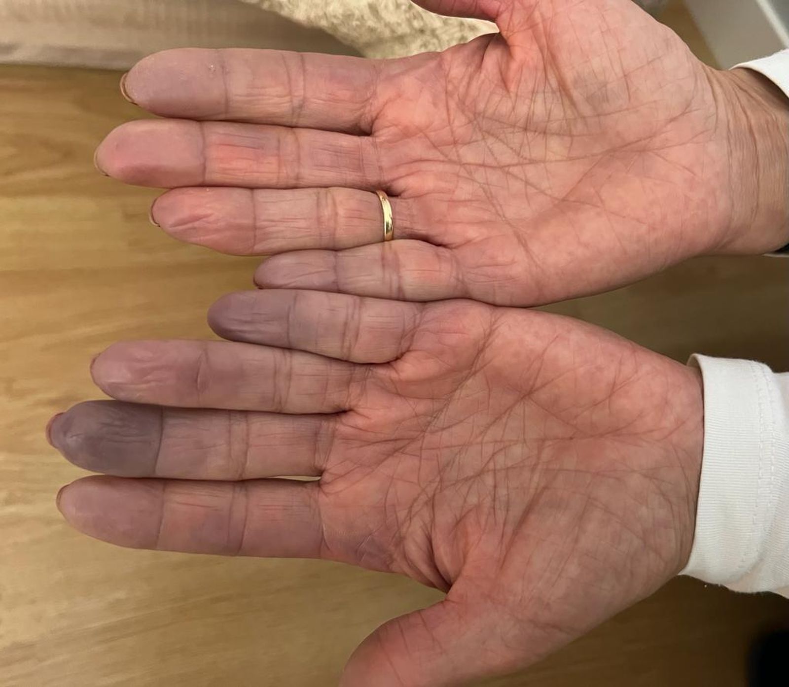 Imagen de manos con Fenómeno de Raynaud
