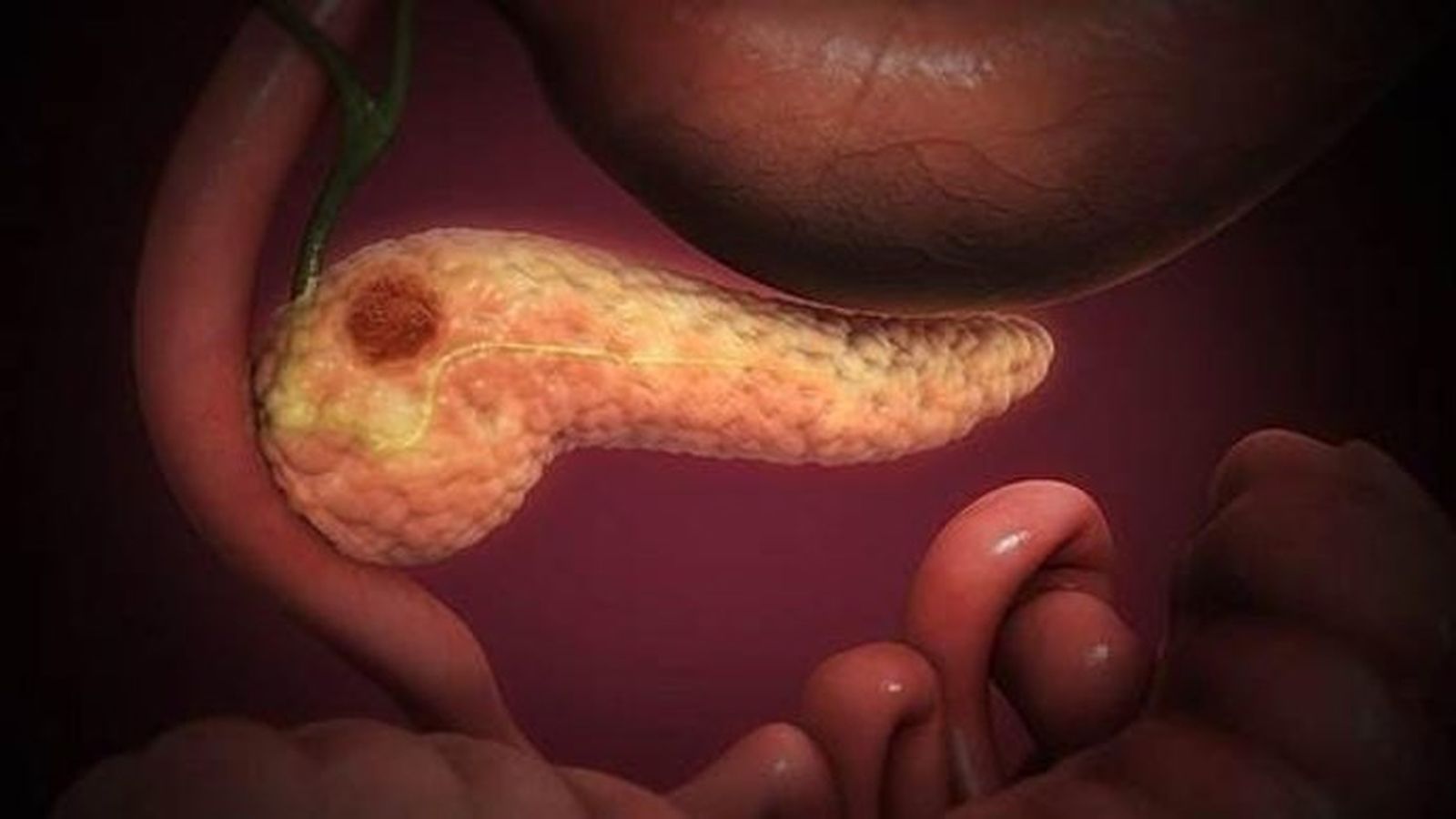 Cáncer de páncreas Cáncer de páncreas