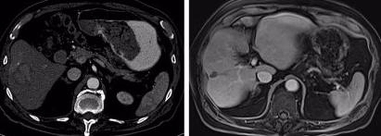 Ensayo en pacientes con cáncer de hígado