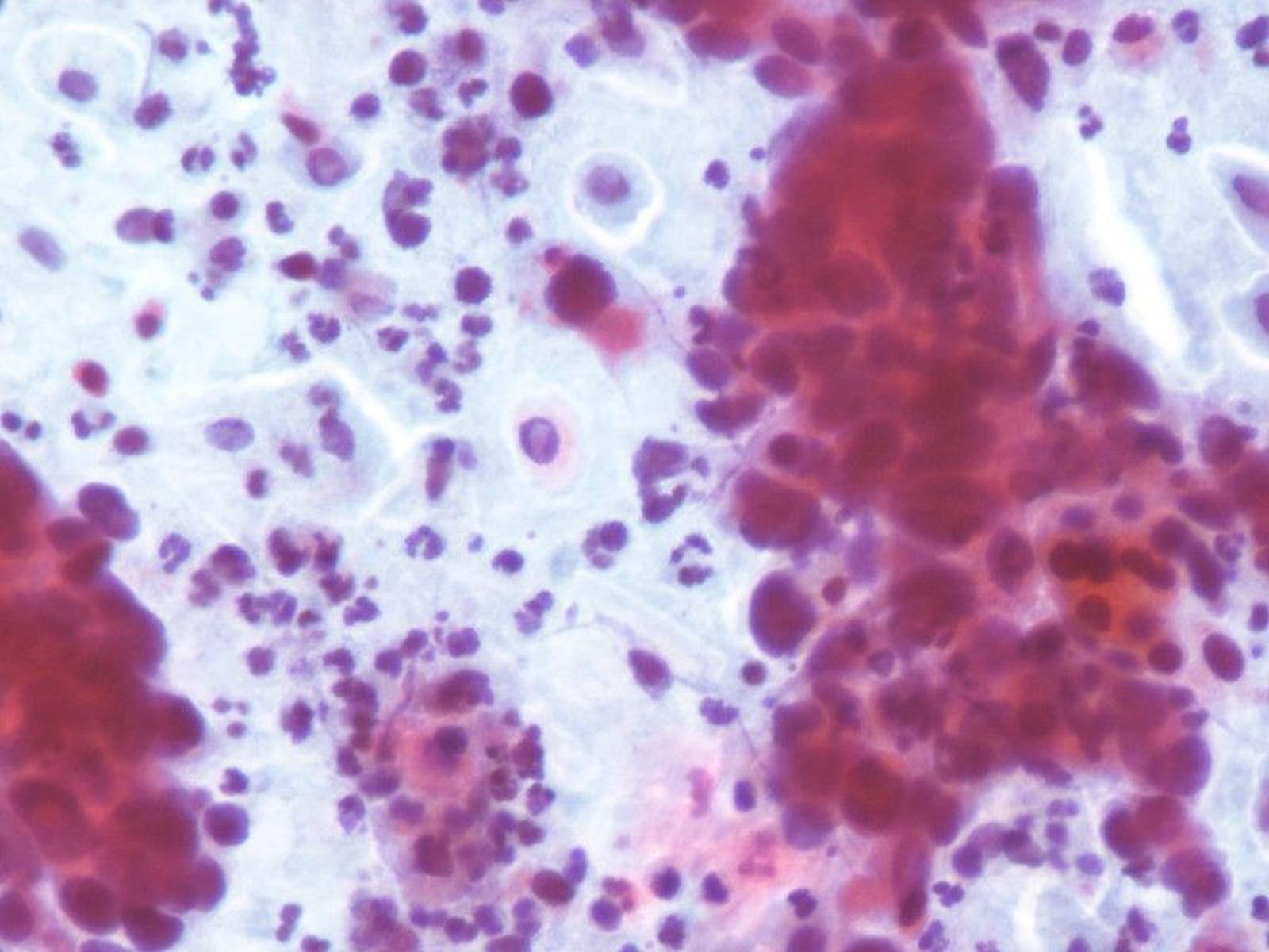 Cáncer de cuello de útero