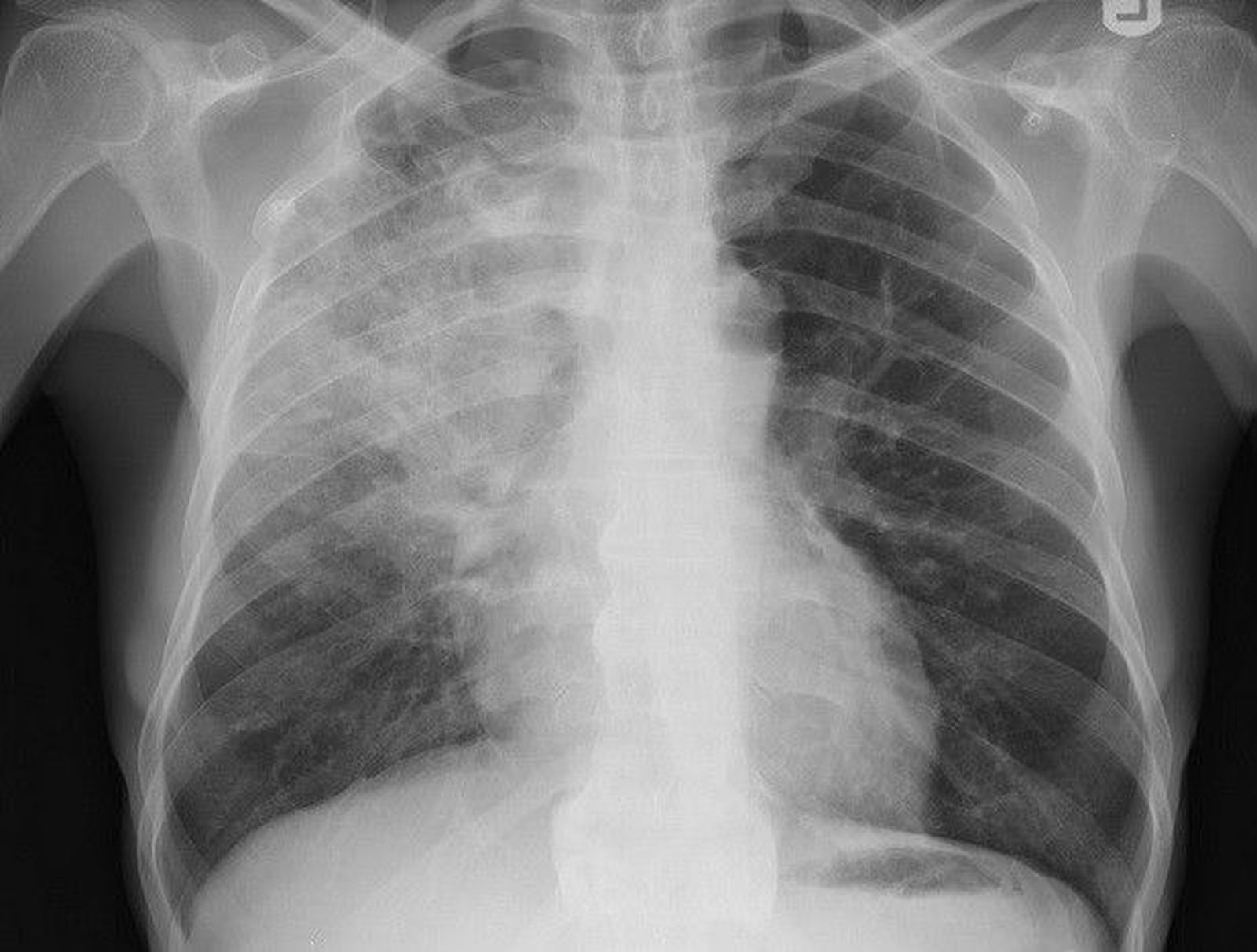 Neumonía, pulmonía, radiografía pulmones Neumonía, pulmonía, radiografía pulmones