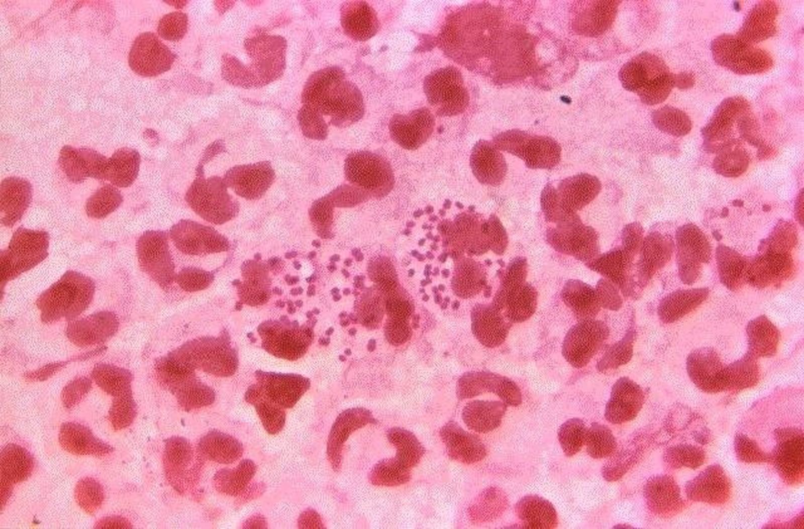Neisseria gonorrhoeae, gonorrea