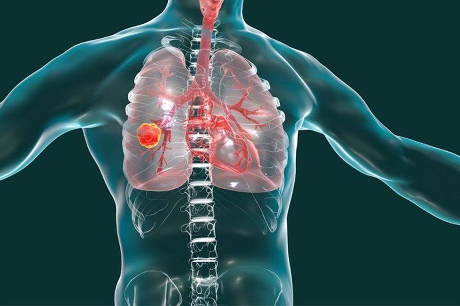 Cáncer de pulmón. Foto ICAPEM | INFOSALUS | EP Cáncer de pulmón. Foto ICAPEM | INFOSALUS | EP