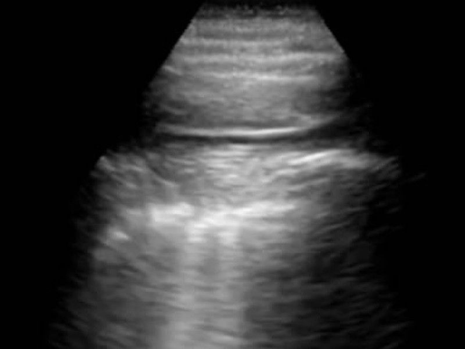 Imagen de una ecografía pulmonar.