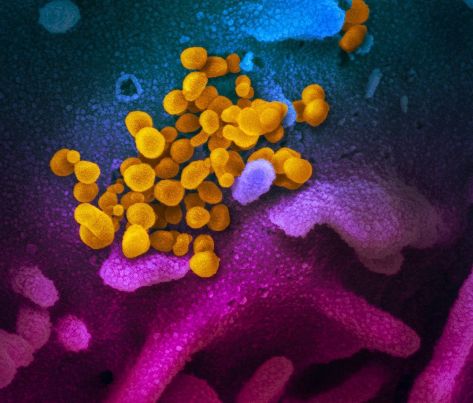 Imagen de microscopio electrónico de barrido muestra SARS-CoV-2 (amarillo), también conocido como 2019-nCoV