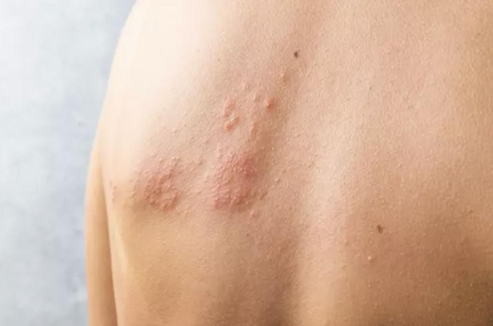 Herpes Zóster | EUROPA PRESS