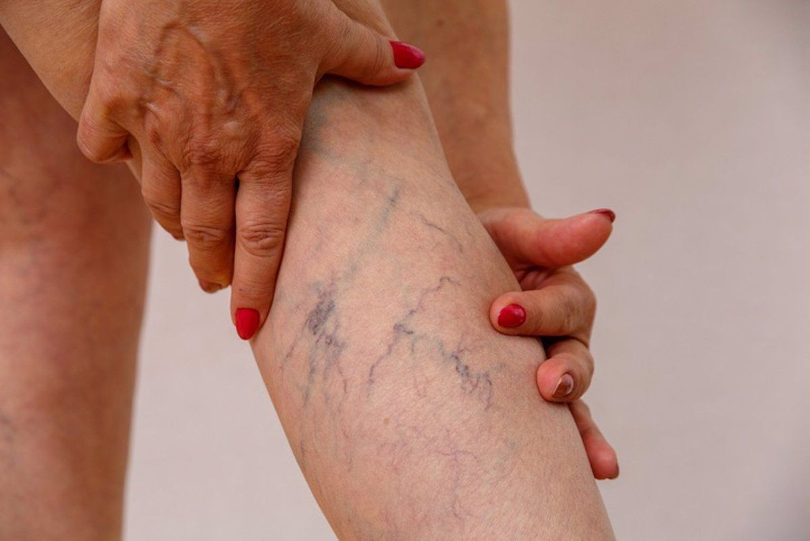 Una pierna con varices. EP