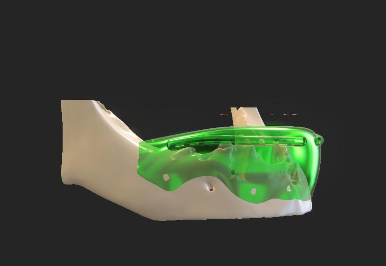 Thumbnail barrera oclusal completa