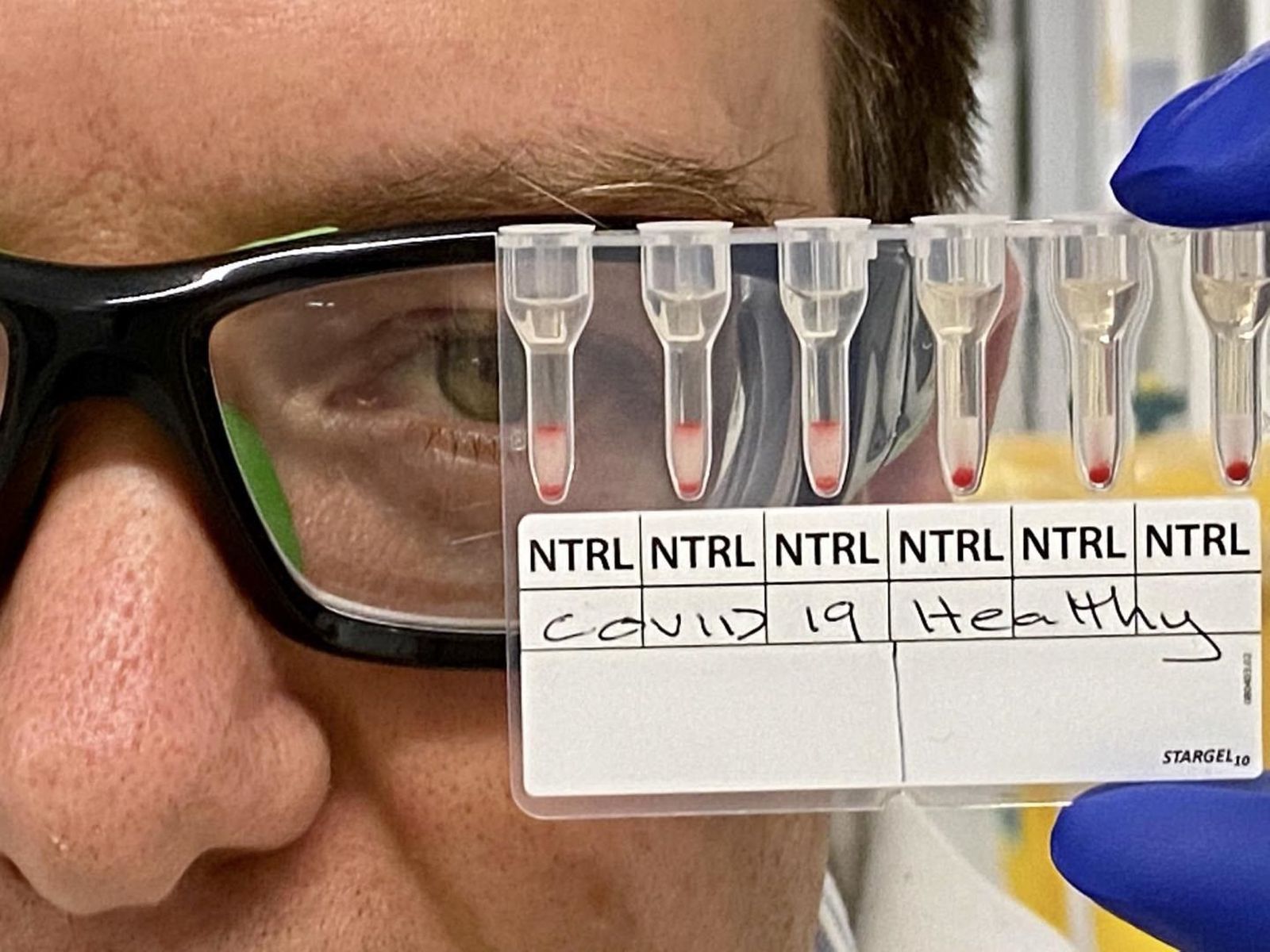 Muestras de sangre COVID-19 positivas y negativas.