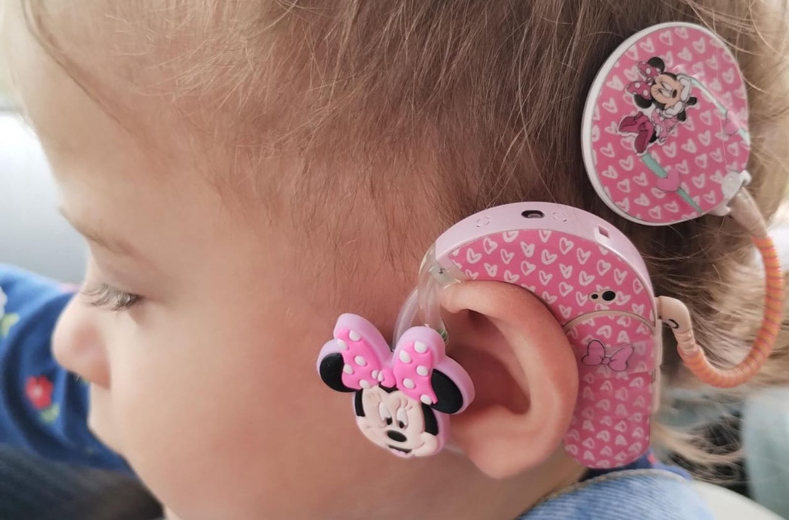 Implante coclear customizado