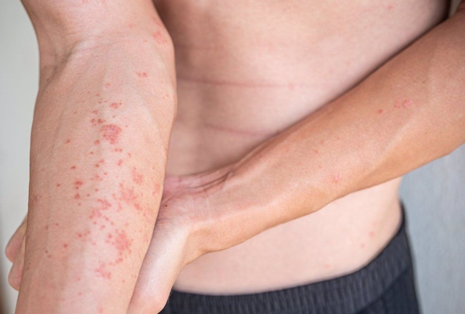 Dermatitis atópica | Fotografía Infosalus