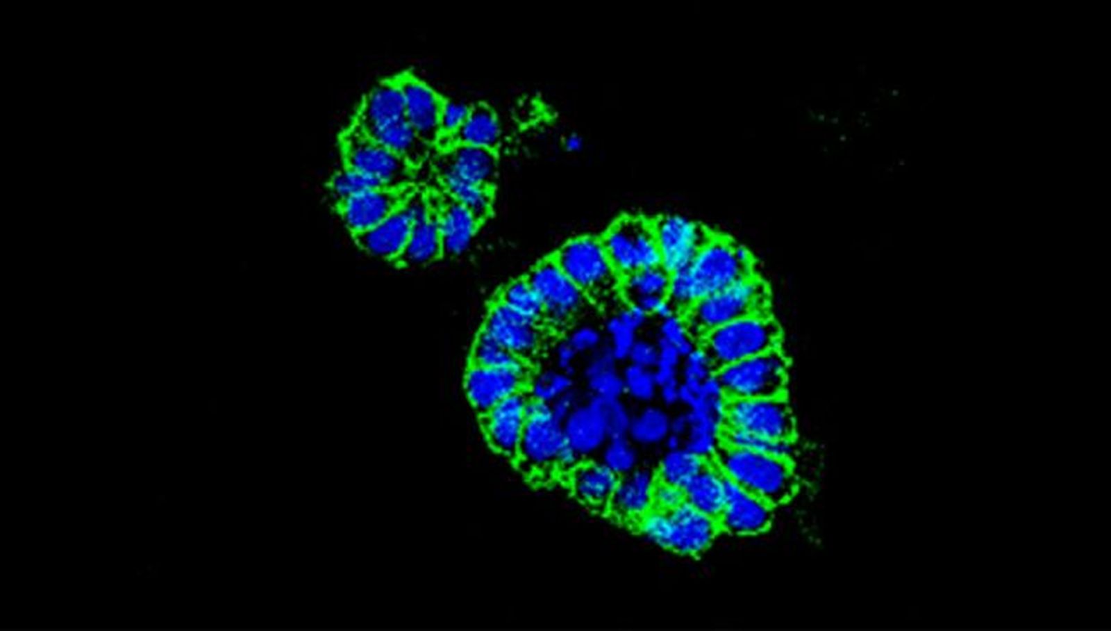 Un nuevo fármaco frente a un transportador de aminoácidos es efectivo en cáncer de colon