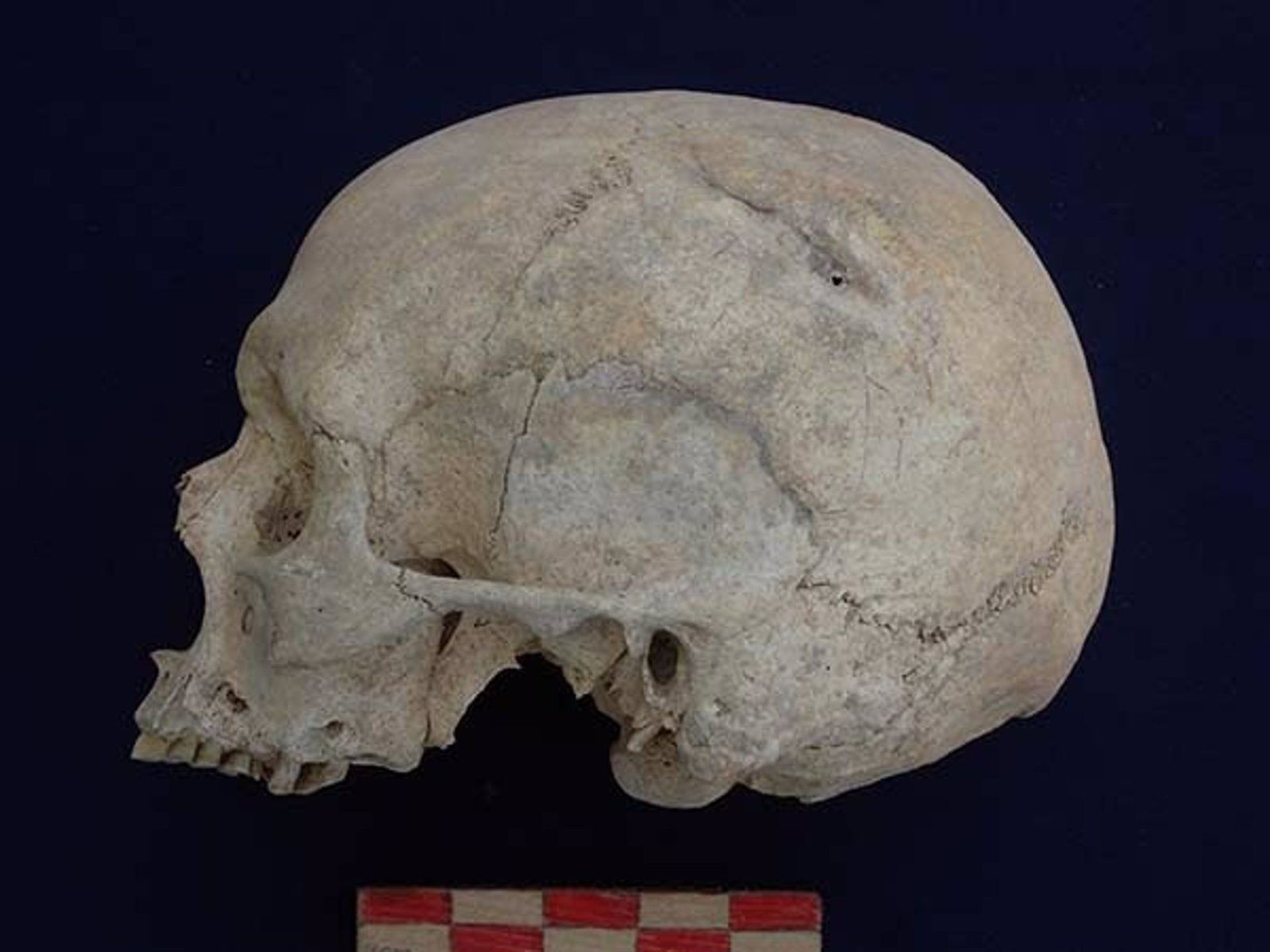 Cráneo con fracturas. EP