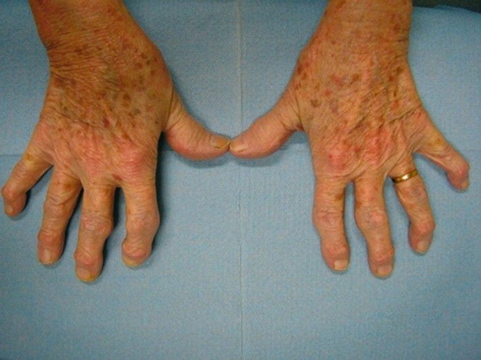 Artrosis en las manos