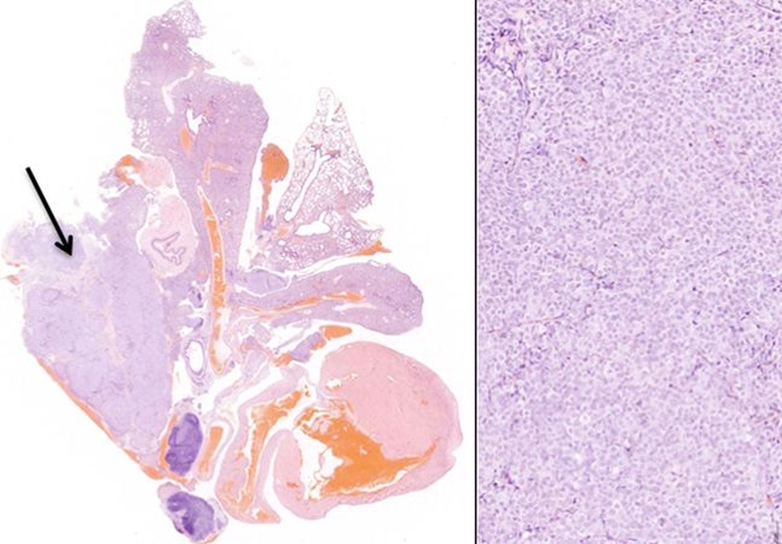 Nuevos abordajes farmacológicos en cáncer de pulmón resistente a tratamiento.