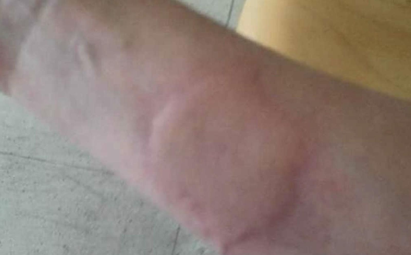 Marcas que le deja a Miryam la urticaria a frigore 