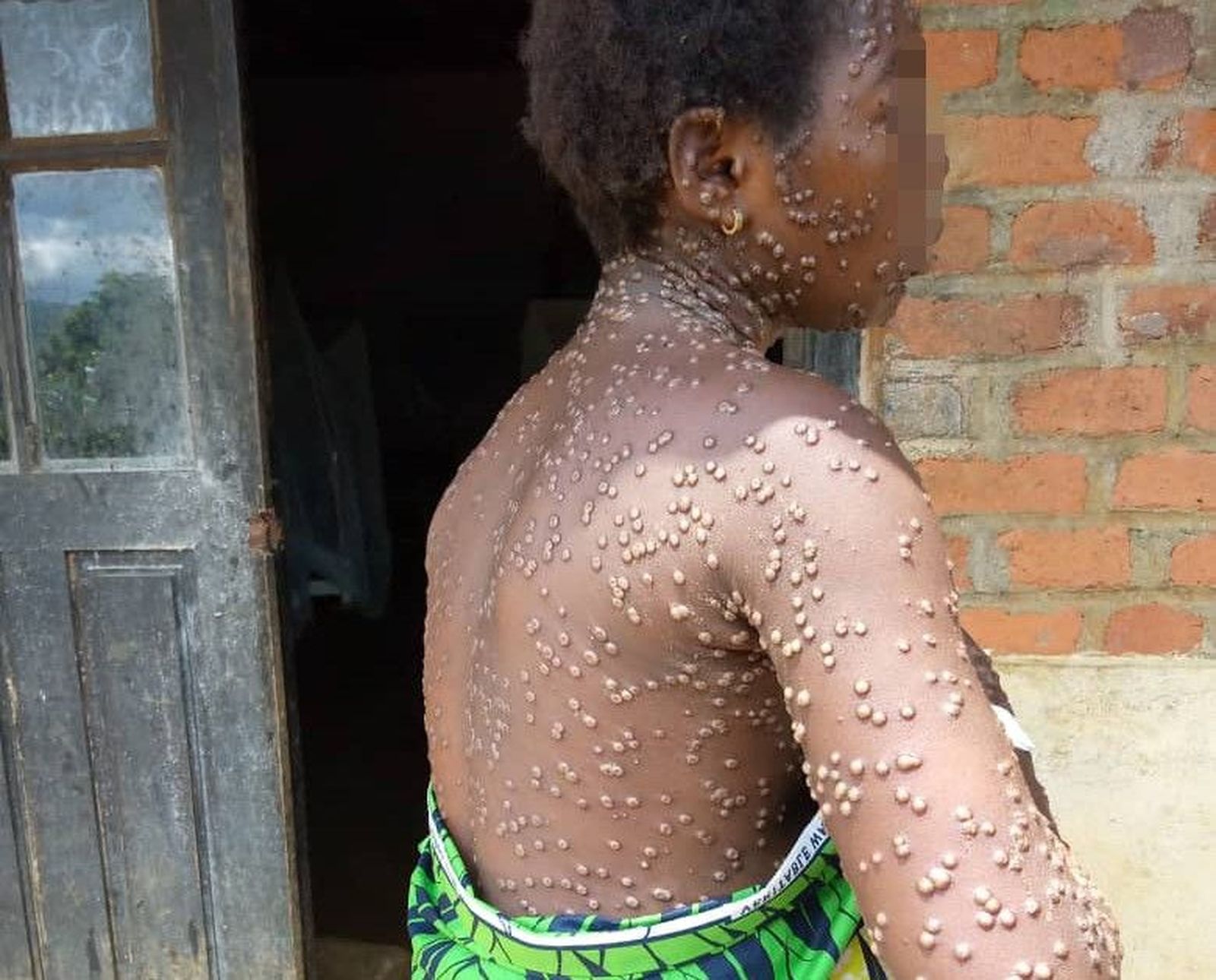 ICAL . Una persona contagiada con mpox en el este de la República Democrática del Congo
