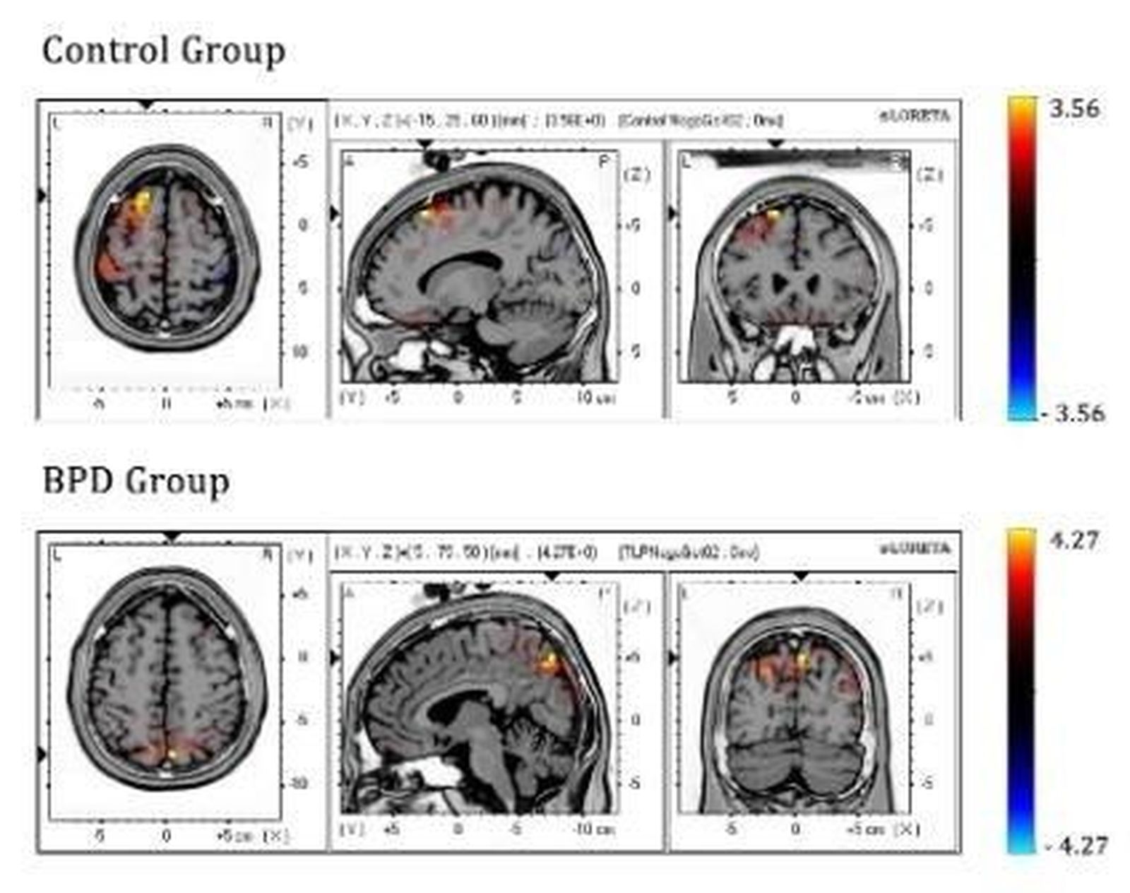 Las personas con trastorno límite de la personalidad activan regiones cerebrales distintas para controlar sus impulsos,