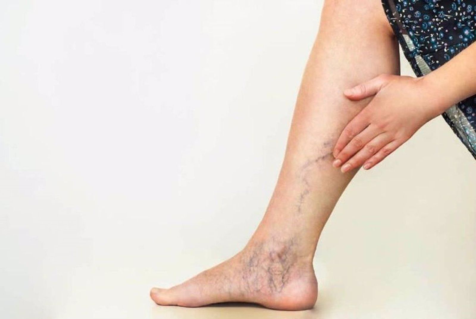 Varices en la pierna. Europa Press