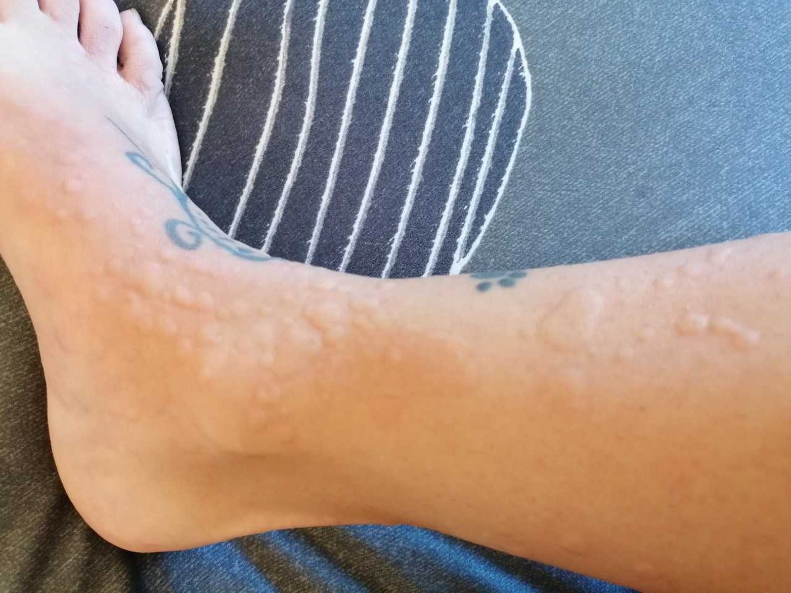 Marcas que le deja a Miryam la urticaria a frigore