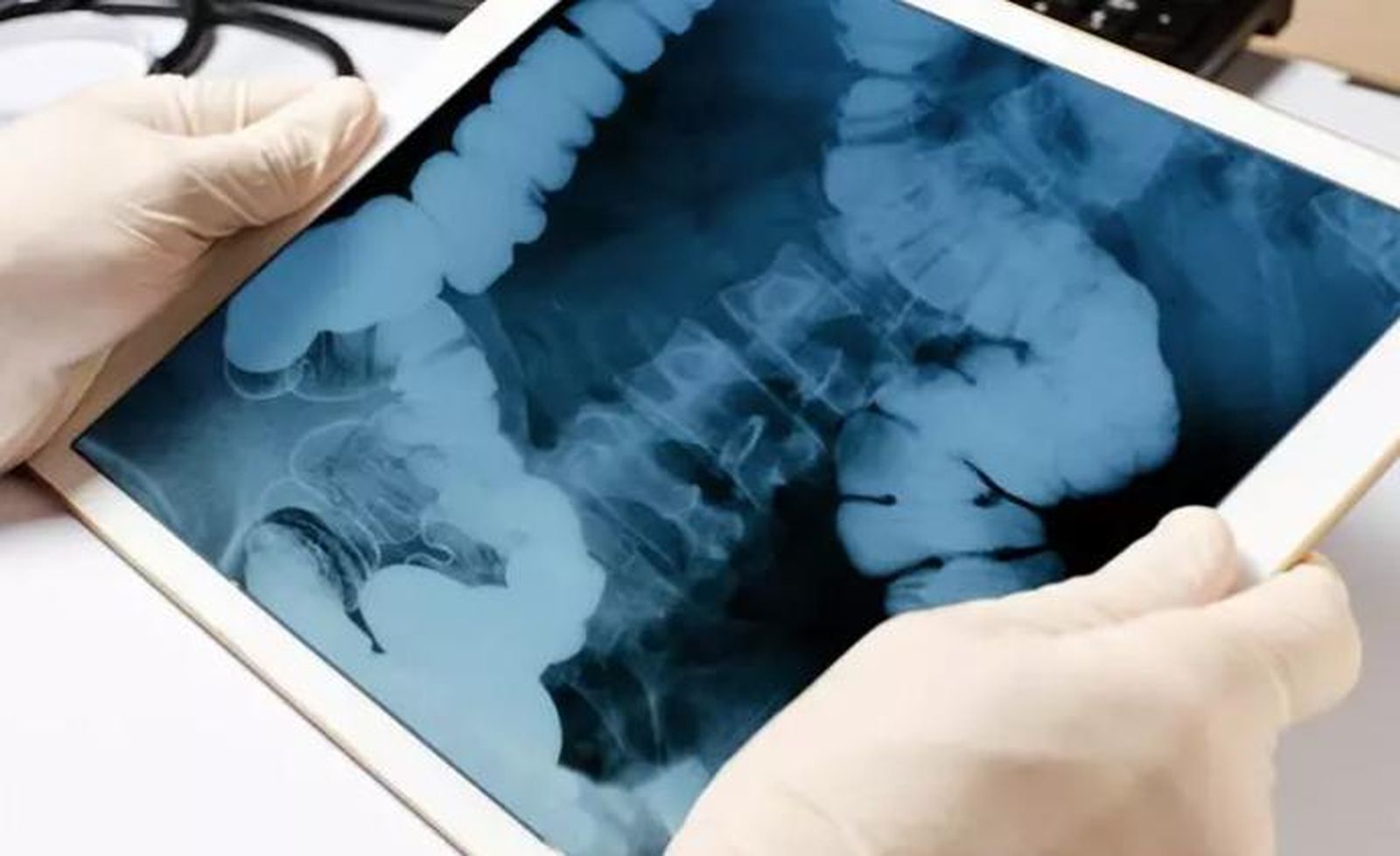 Radiografía del intestino. - ISTOCK - Archivo