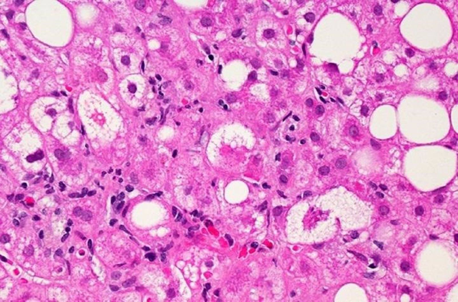 Tejido hepático afectado por la enfermedad del hígado graso no alcohólico. - DR. DAVID KLEINER, NCI - Archivo