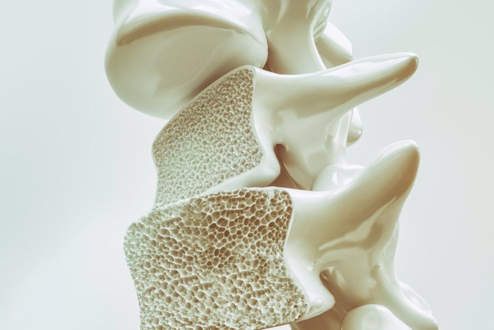 Osteoporosis. Foto Infosalus