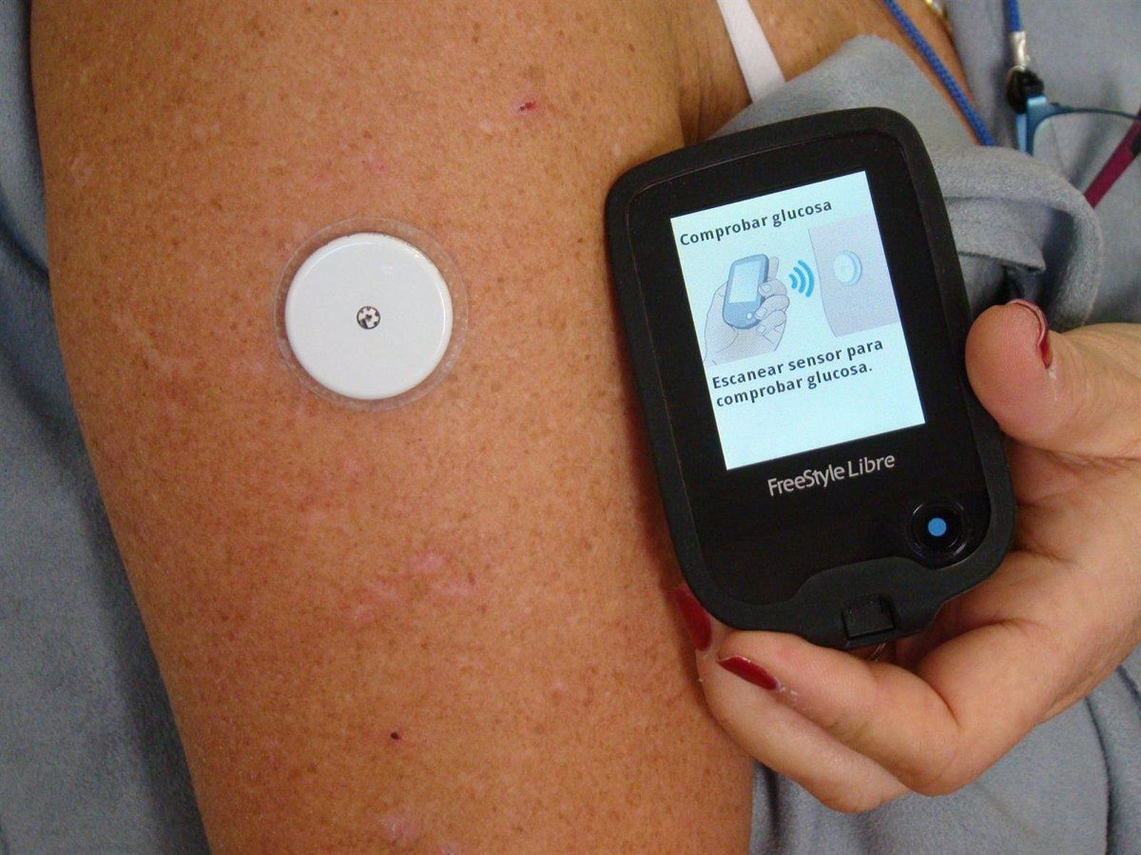 'sistema flash' de monitorización de glucosa