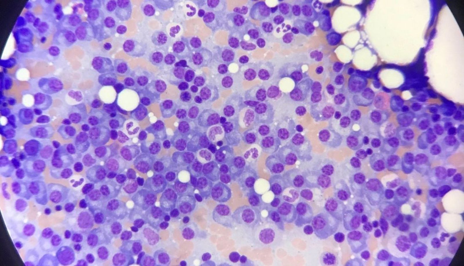 Mieloma múltiple. EP