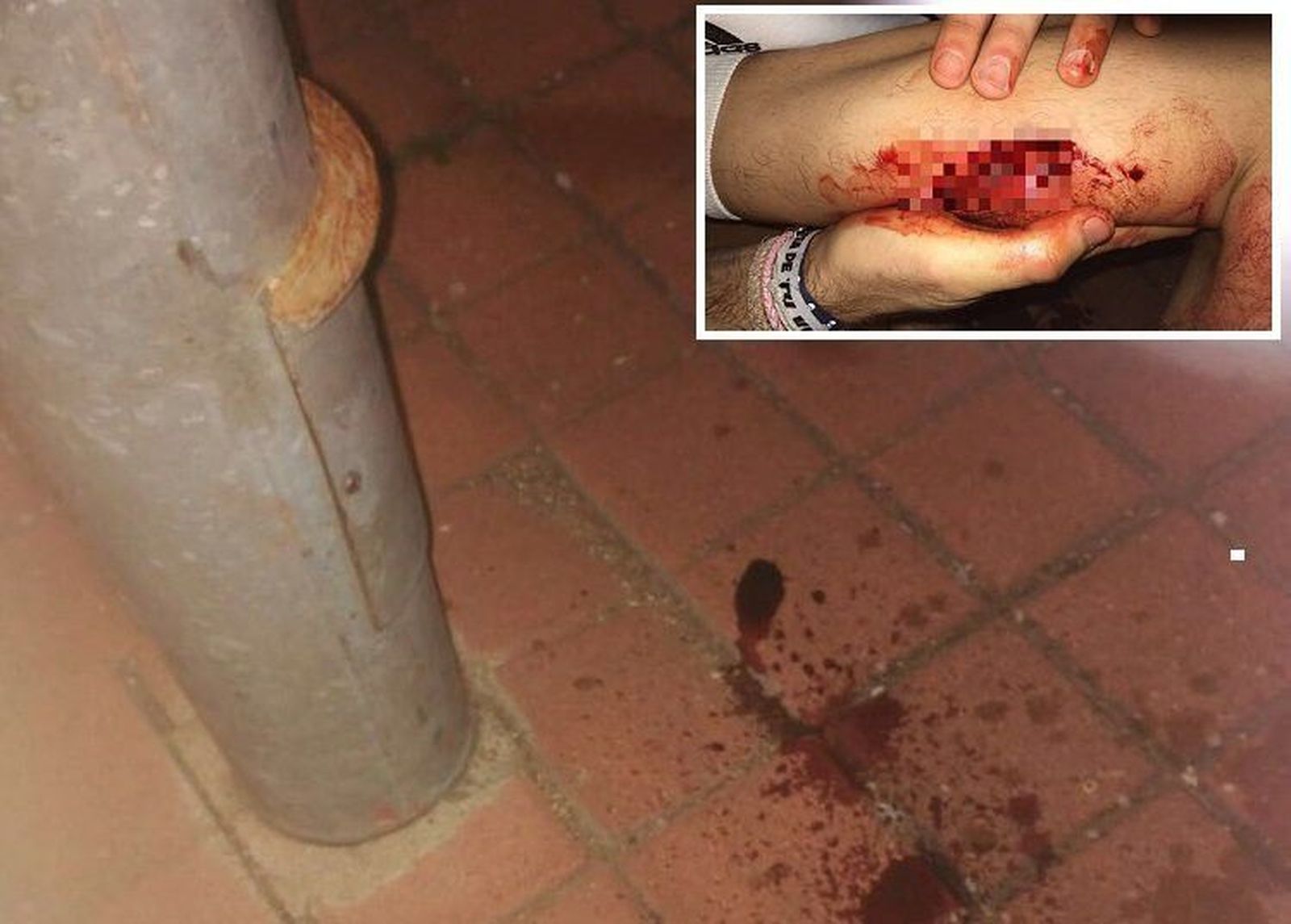 Recibe 30 puntos en un gemelo tras golpearse con una farola en Santa Marta