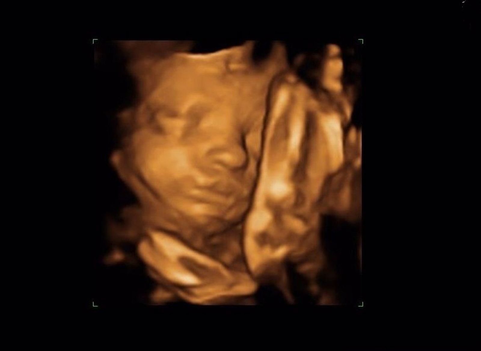 Ecografía. Foto Infosalus