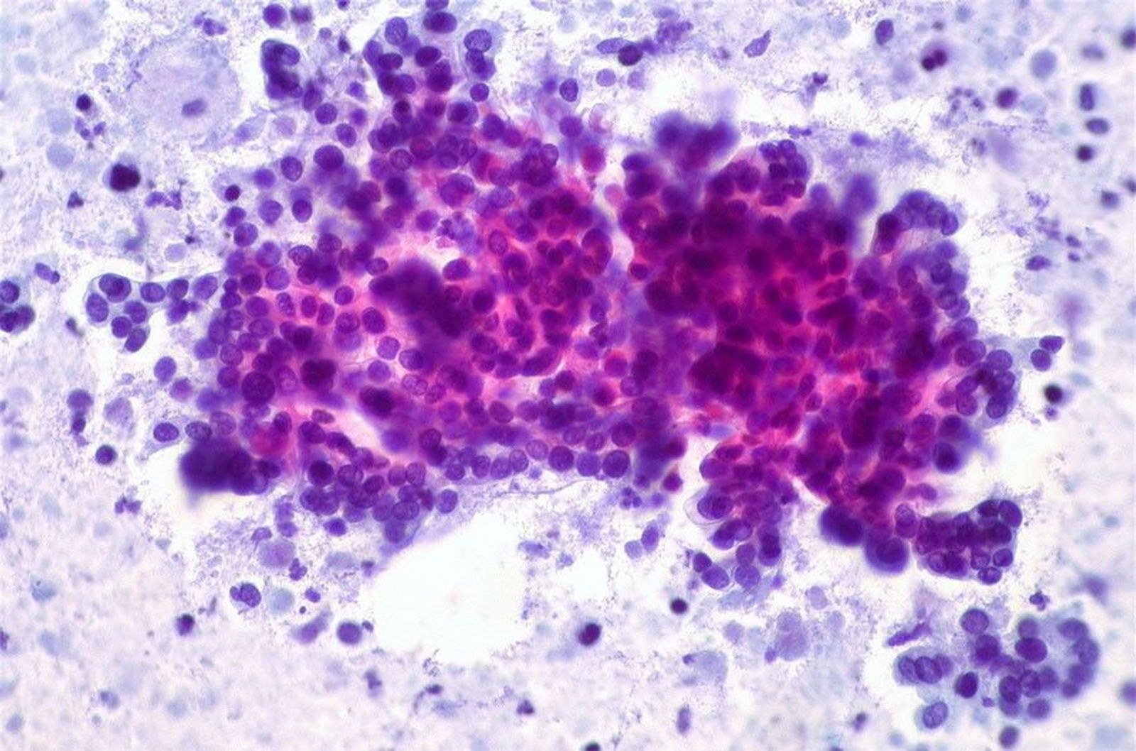 Cancer pancreas
