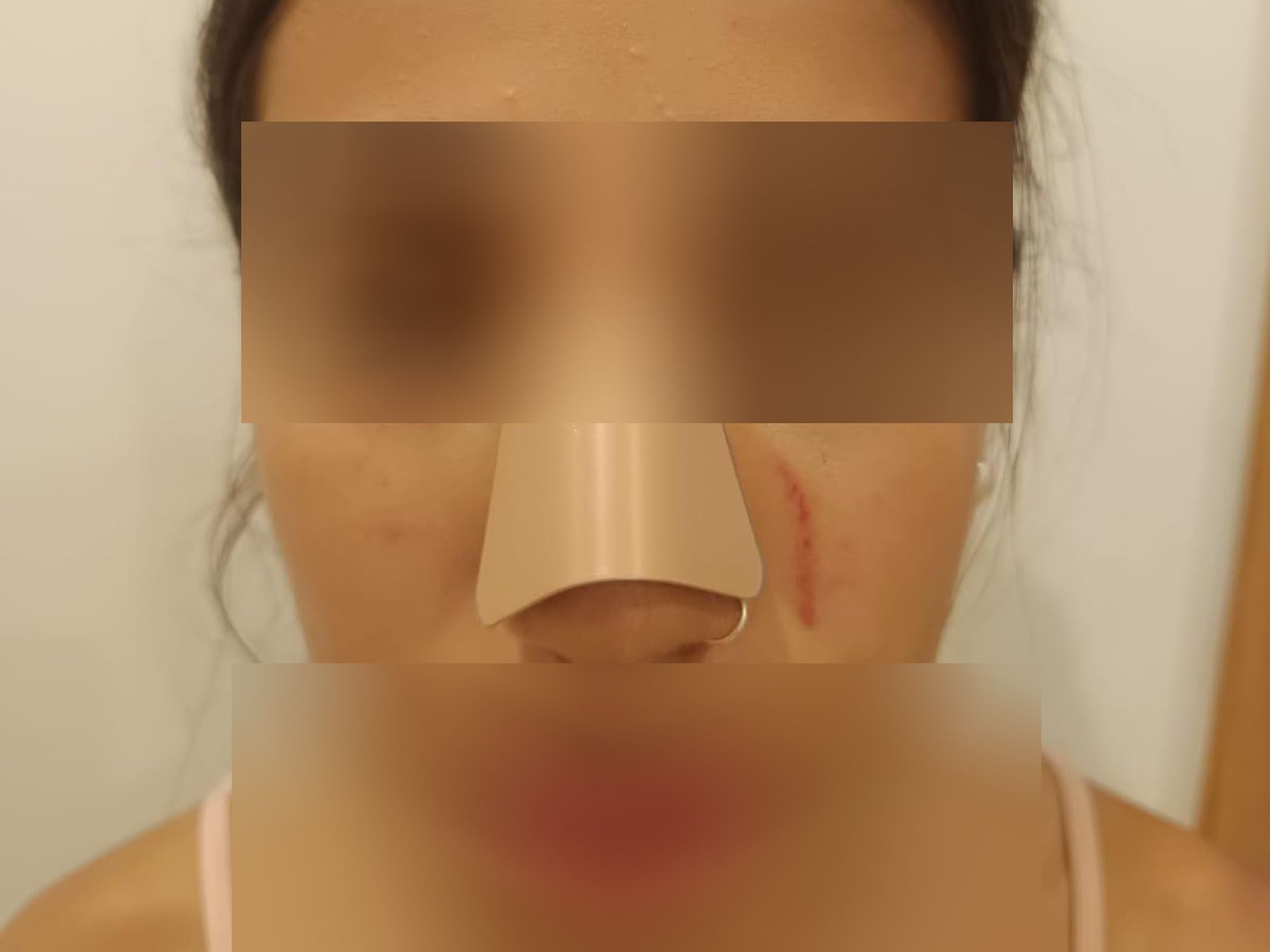 Lesiones que presentaba la niña una vez atendida por personal sanitario