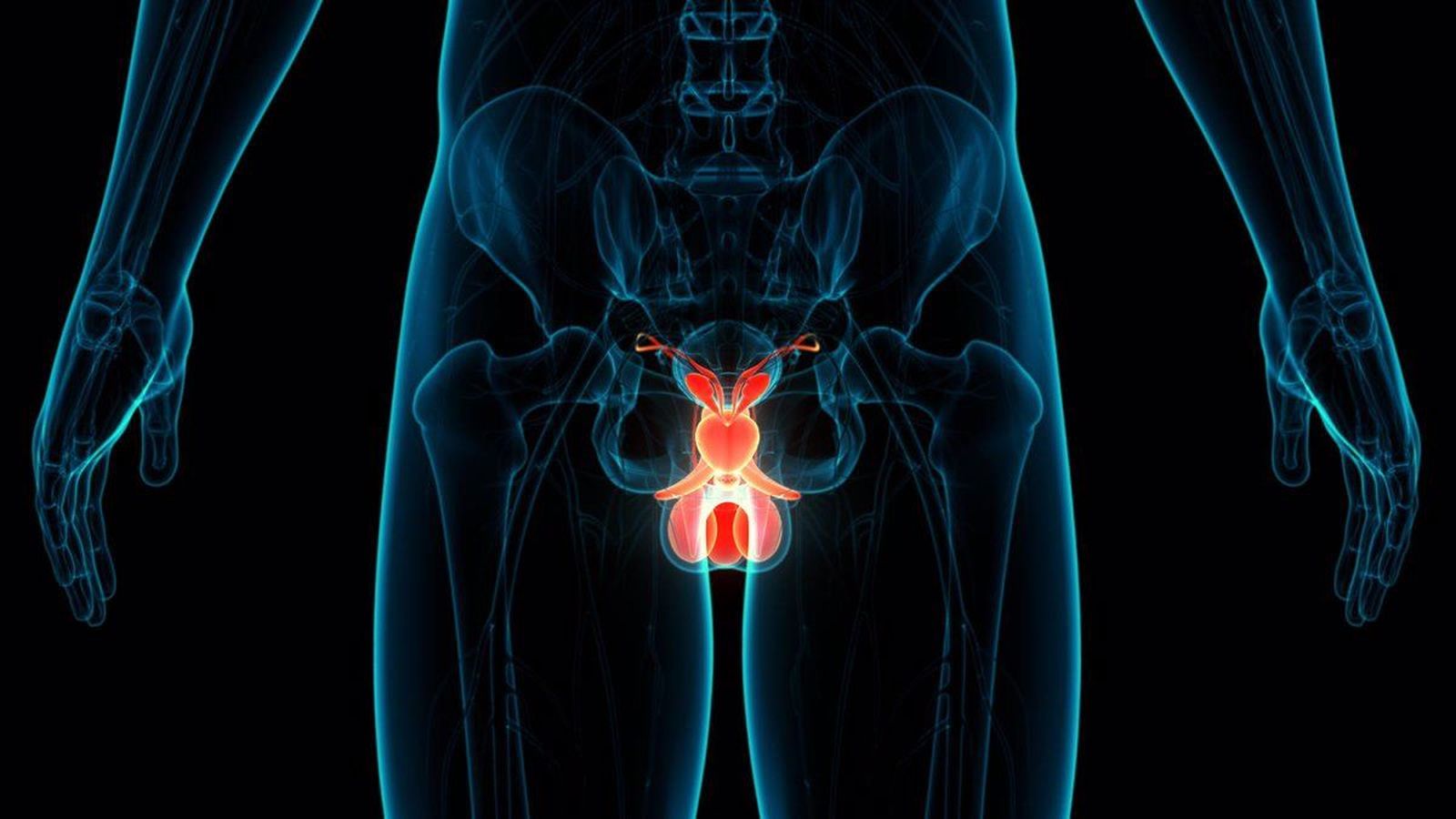 Cáncer de próstata. Foto Infosalus